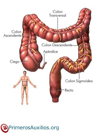 Cáncer de colon y sus síntomas