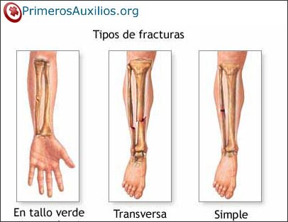 Clasificación y tipos de fracturas