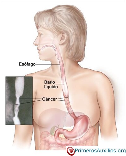Síntomas de cáncer de estómago y su tratamiento